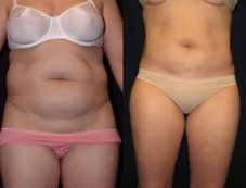 Liposuction and Mini Tuck